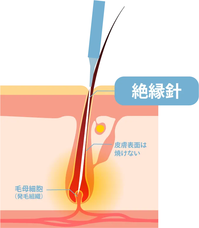 当院のニードル脱毛