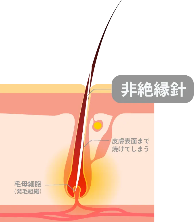 非医療機関のニードル脱毛