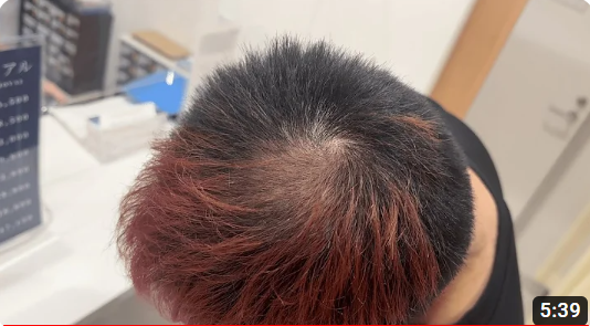 【胸毛二キ様YouTube】ハゲ治療、始めます