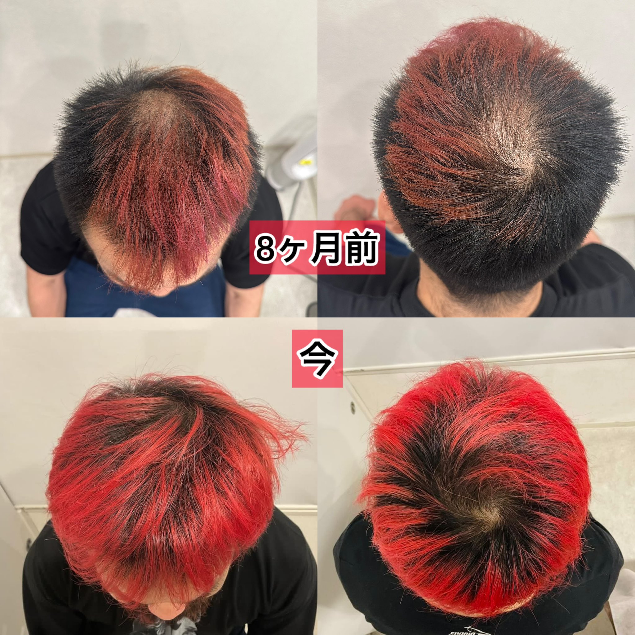 【胸毛二キ】AGA治療経過【八須拳太郎様】